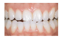 Laser Whitening