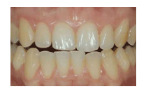 Laser Whitening