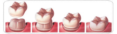 Dental Crowns