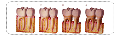 Gum Treatment