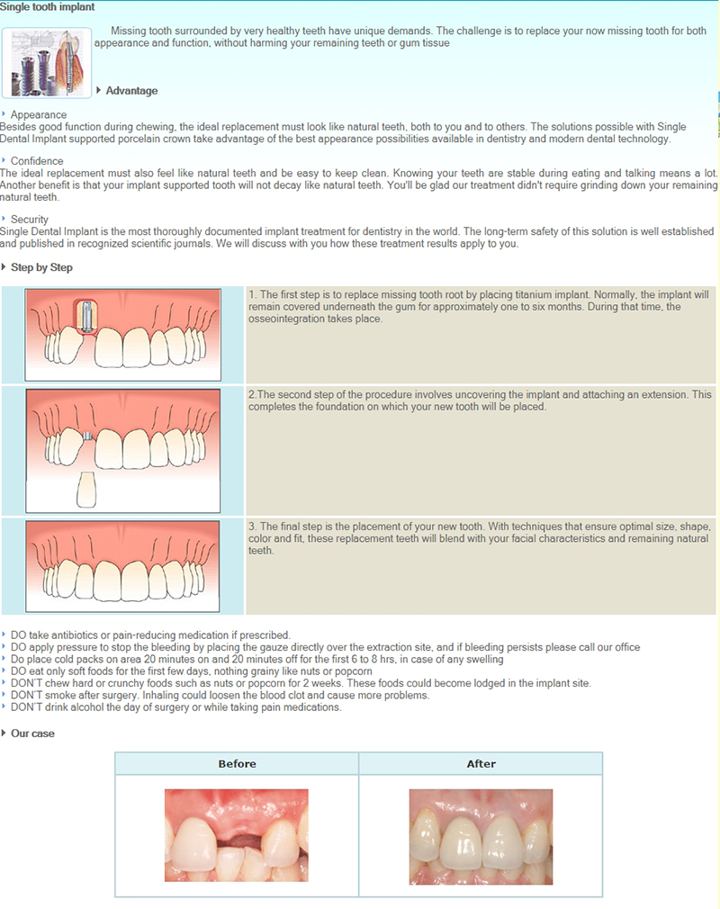 Dental Implants