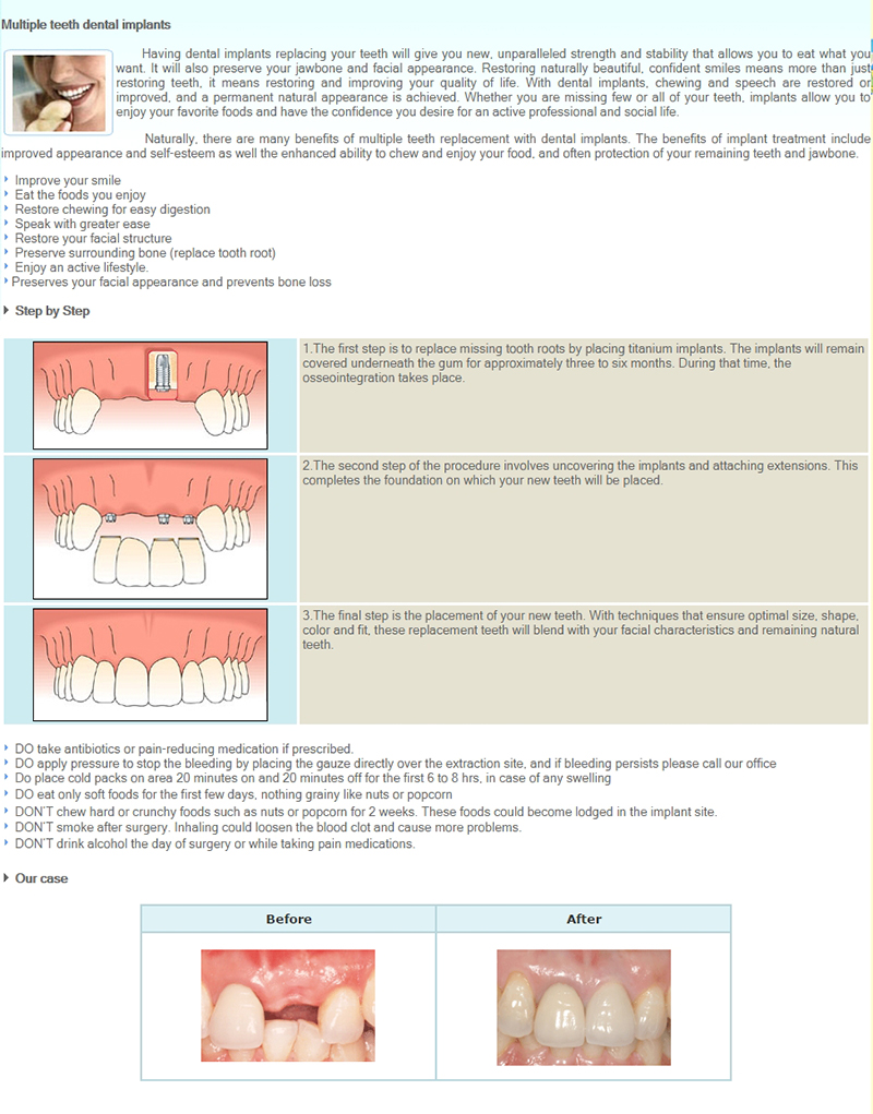 Dental Implants