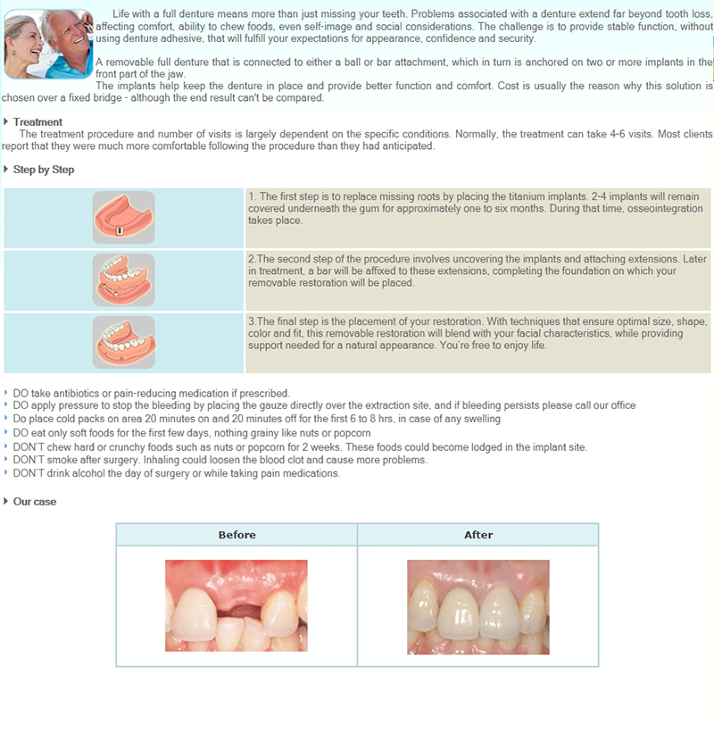 Dental Implants