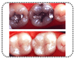 tooth color fillting