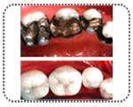 tooth color fillting