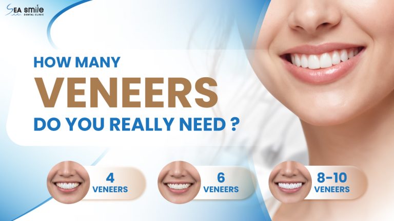How Many Veneers Do You Need