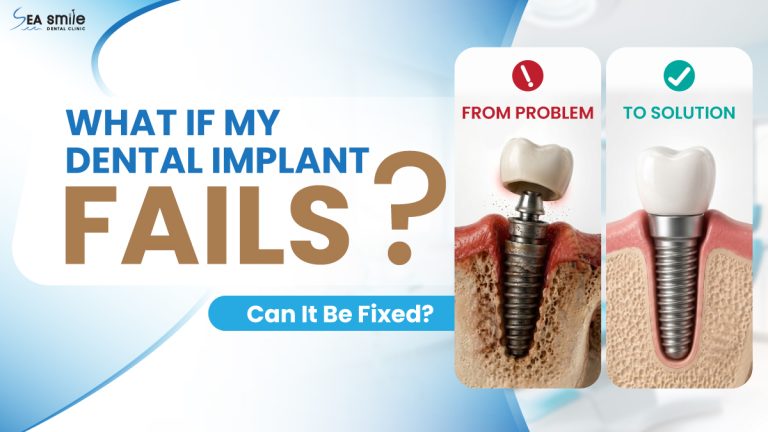 What If My Dental Implant Fails