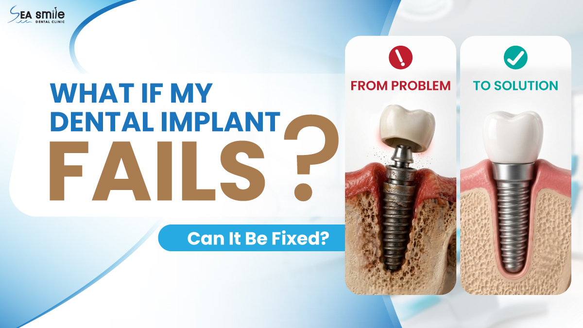 What If My Dental Implant Fails
